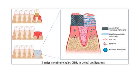 Rhabdophane: Bioceramic Material for Superior Bone Regeneration and Dental Applications!